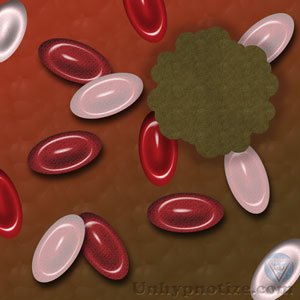 A depiction of cancer with blood cells within the body.